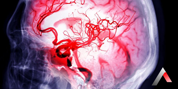 Beyin Damar Tıkanıklığı